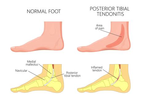 Posterior Tibial Tendonitis Symptoms Causes Treatments