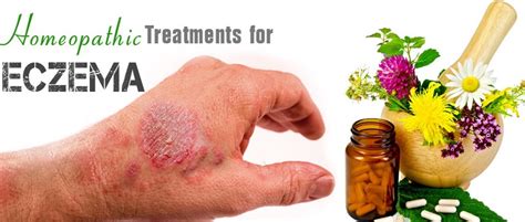 Homeopathy Treatment For Eczema Sofea Homeopathy Center