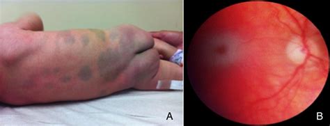 Mongolian Spots Are Not Always A Benign Sign The Journal Of Pediatrics