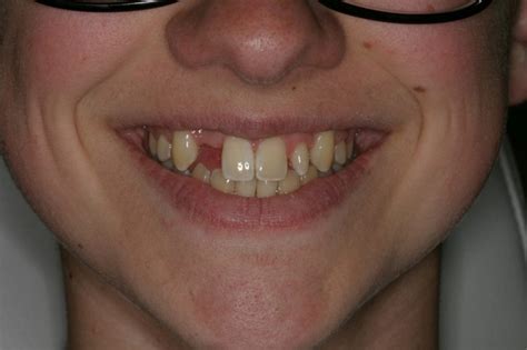 Before And After Dental Photos Pittsburgh Pa Smile Gallery