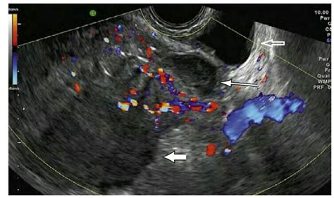 Bladder Flap Hematoma Transvaginal Ultrasound In An Oblique Transverse