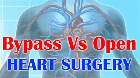 What Is The Difference Between Bypass Surgery And Open Heart Surgery