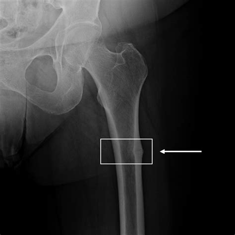 Diagnosis Of Proximal Femoral Insufficiency Fractures In Patients Receiving Bisphosphonate