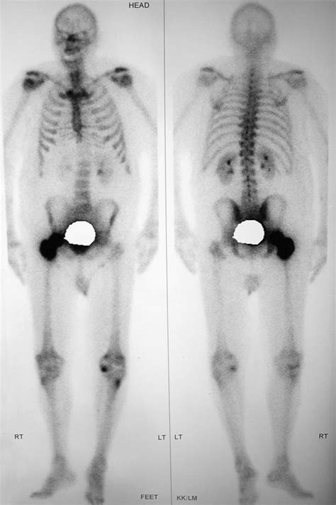 70 Year Old Male With Prostate Carcinoma Radionuclide Bone Scan Of The