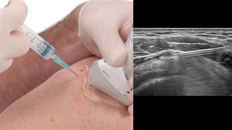 Ultrasound Guided Injection Technique For Costotransv