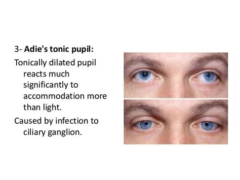 Image Result For Adies Tonic Pupil Pupil Tonic Study Guide