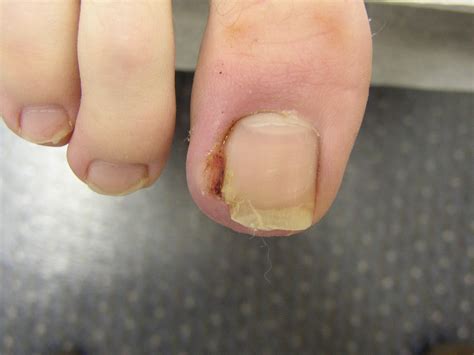 Nail Disorders Med