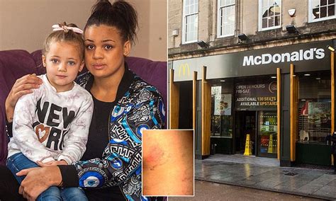 Mcdonalds Superglue Toilet Prank Rips Skin Off Of Kaya Langmeads Legs