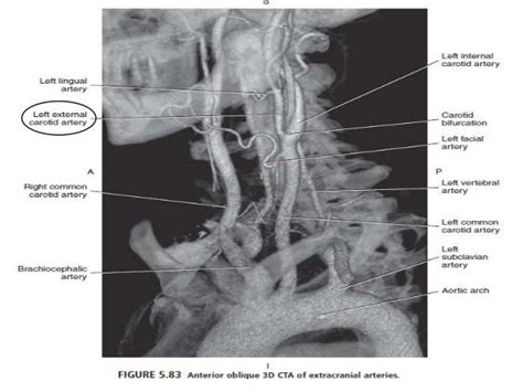 Ct Angiography Head And Neck