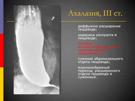 Диета при склеродермии системной Заболевания пищевода. Ахалазия кардии. Эзофагопатия при системной Заболевания пищевода. Ахалазия кардии. Эзофагопатия при системной Диета при склеродермии системной