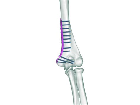 True Lock Distal Humerus Medial Plate Truemed Medikal