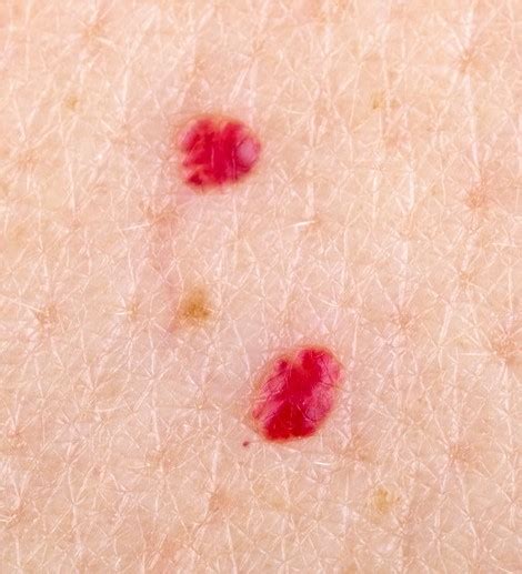 This Is Why You Have Red Marks On Your Skin Flipboard
