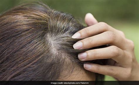 Premature Greying Of Hair Know The Causes And Tips For Prevention From