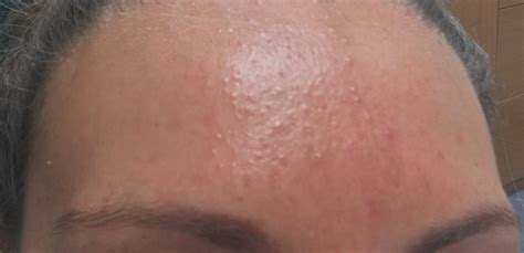 Small Colourless Bumps On My Forehead General Acne Discussion Acne