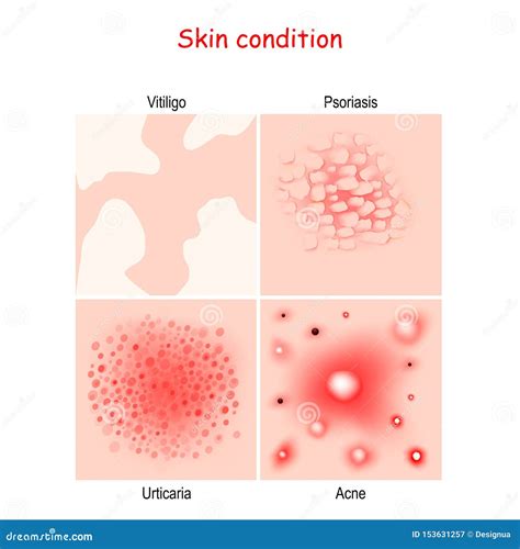 Skin Condition And Diseases Close Up Of Acne Urticaria Psoriasis