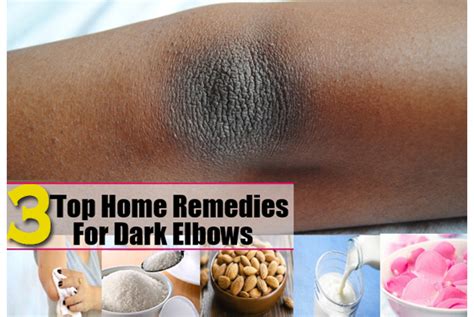Three Simple Ways Of Removing Dry And Dark Skin On The Elbows Must