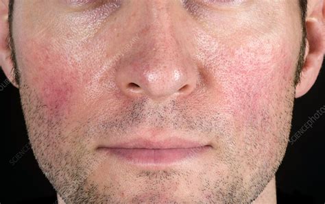 Acne Rosacea Stock Image C0461006 Science Photo Library