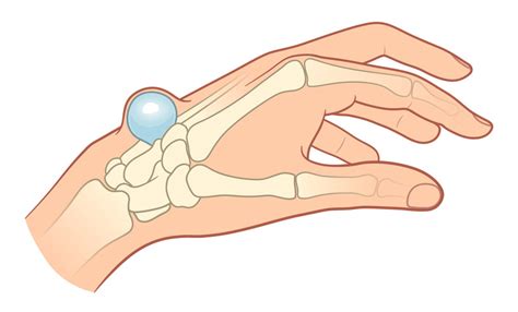 Ganglion Inaczej Torbiel Galaretowata Przyczyny Objawy Leczenie