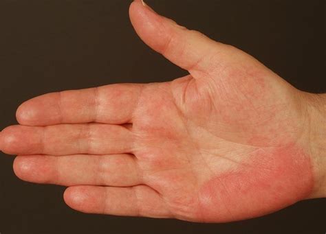 Palmar Erythema Pictures Definition Causes Treatment