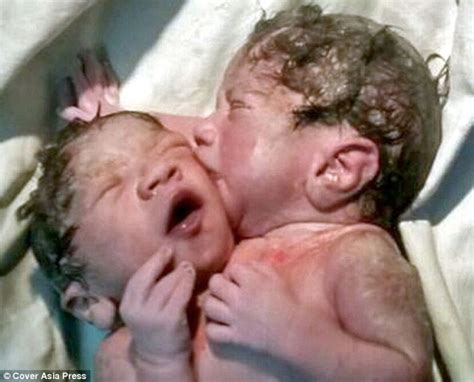 Photo Of Conjoined Twins Kissing Goes Viral Photos