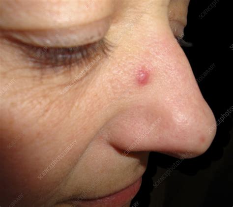 Merkel Cell Carcinoma On A Womans Nose Stock Image C0583265