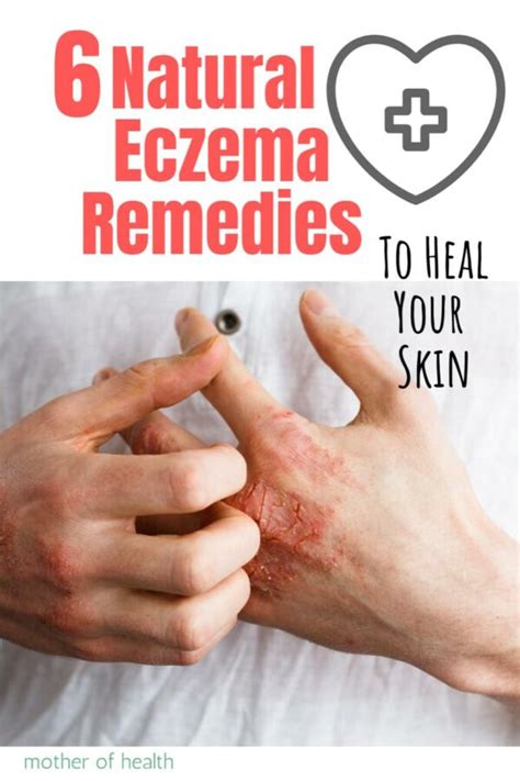 6 Natural Eczema Remedies To Heal Your Skin Mother Of Health