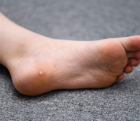 Pediatric Cutaneous Warts And Verrucae An Update Lower Extremity