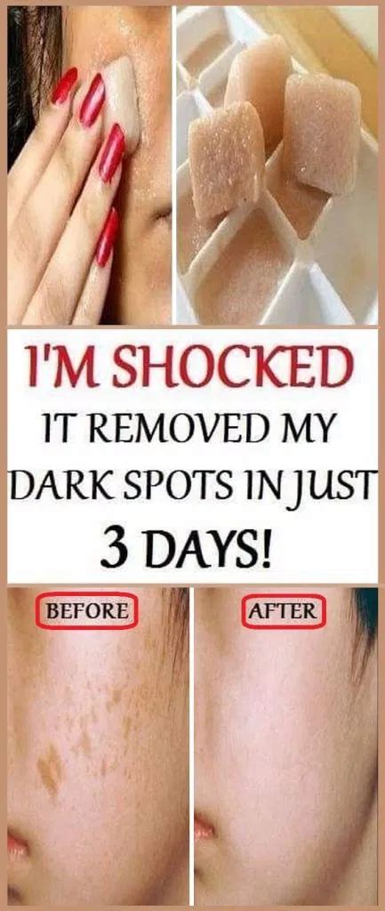 Im Shocked It Removed My Dark Spots In 3 Days Magic Remedy Healthy