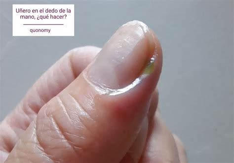 Sintetiza más de imágenes sobre como curar los padrastros de las uñas recién actualizado
