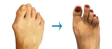 Before And After Foot Surgery Image Gallery London Foot And Ankle Surgery