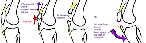 Broken Kneecap Patella — Bone Talks
