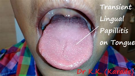 Transient Eruptive Lingual Papillitis On Tongue After Viral Infection