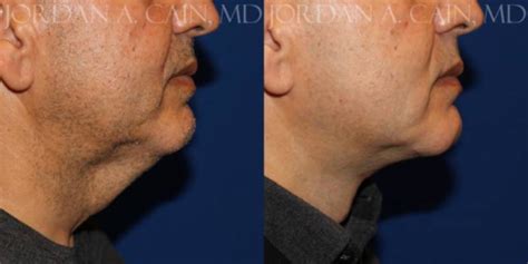 56 Year Old Man Treated With Direct Neck Lift Pic By Dr Jordan Cain