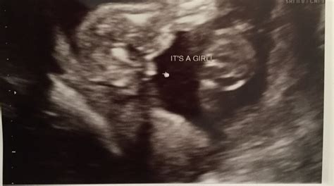 How To Tell Gender On Ultrasound 13 Weeks