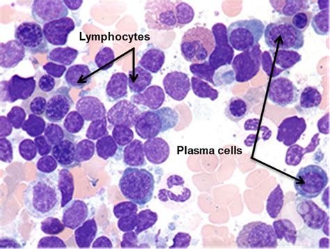 Lymphoma Action Waldenströms Macroglobulinaemia And