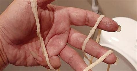 Man Gets The Shock Of His Life After 32 Ft Long Tapeworm Crawls Out His Body