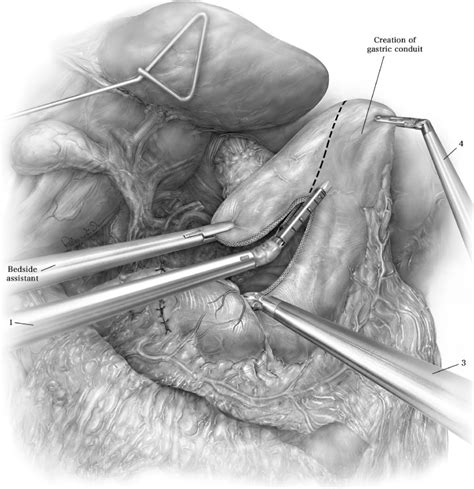 Ivor Lewis Robotic Assisted Minimally Invasive Esophagectomy Ramie