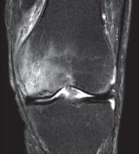 Mr Image Showing Bone Marrow Edema Of The Medial Femur Condyle With A