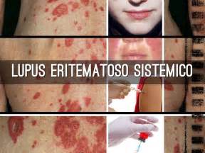 Pruebas Inmunologicas Para Lupus Eritematoso Sistemico Kulturaupice