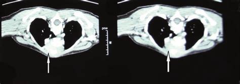 Axial Contrast Enhanced Computed Tomography Showing That The Mass Is