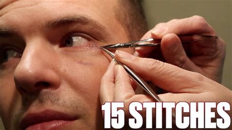 How To Remove Stitches From Eyebrow Eyebrowshaper