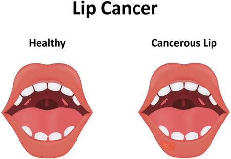 Learn Bump On Inside Of Lip Causes And Treatment Of White Spots Porn Sex Picture