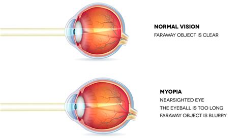 A Comprehensive Guide To Myopia Short Sightedness Laser Eye Surgery Hub