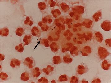 Recurrent Streptococcus Pneumoniae F Meningitis Due To Cerebrospinal