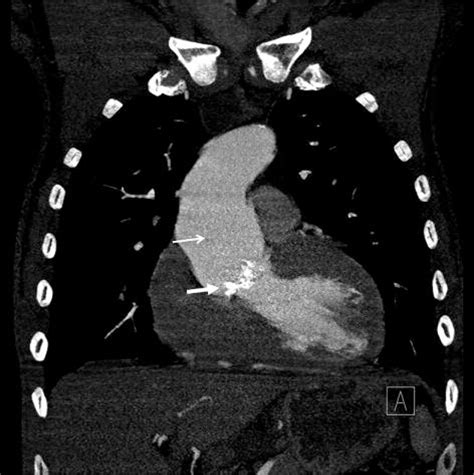 Ecg Gated Angio Ct Of The Thoracic Aorta Mpr Multiplanar Reformatted