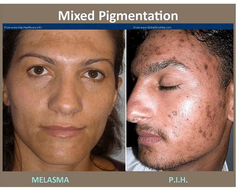 Melasma Treatment Skin Md And Beyond