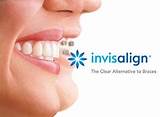 Pictures of Invisalign Does Insurance Cover It