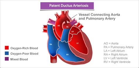 Patent Ductus Arteriosus Boston Childrens Hospital
