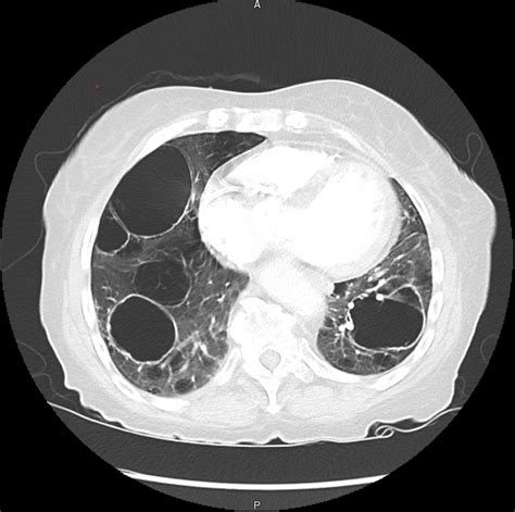 Cureus An Unusual Case Of Severe Cystic Lung Disease A Case Report