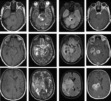 Glioblastoma Multiforme Radiology Cases